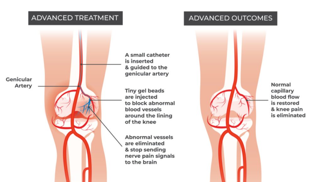 Genicular Artery Embolization