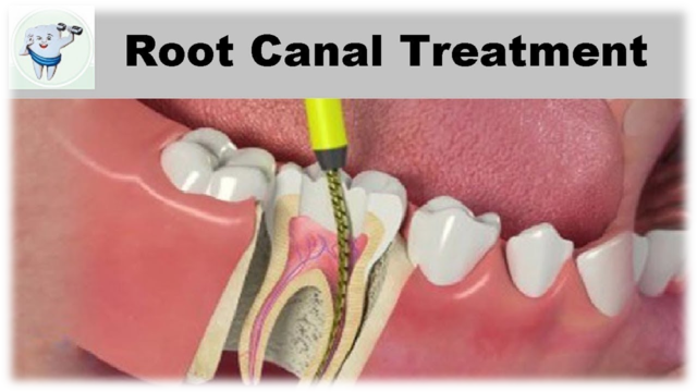 Root Canal Treatment Kawana