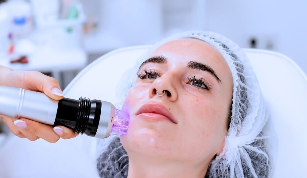 RF microneedling