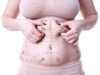Long-Lasting Results: Dubai’s Best Fat Transfer Surgeons Share Their Techniques Long-Lasting Results: Dubai’s Best Fat Transfer Surgeons Share Their Techniques