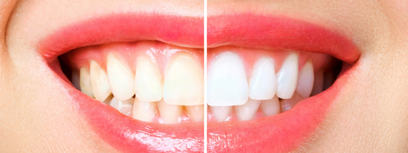 Teeth Whitening