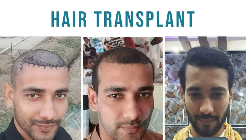 best hair transplant in lahore