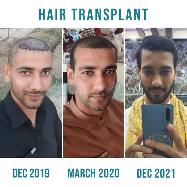 best hair transplant in lahore