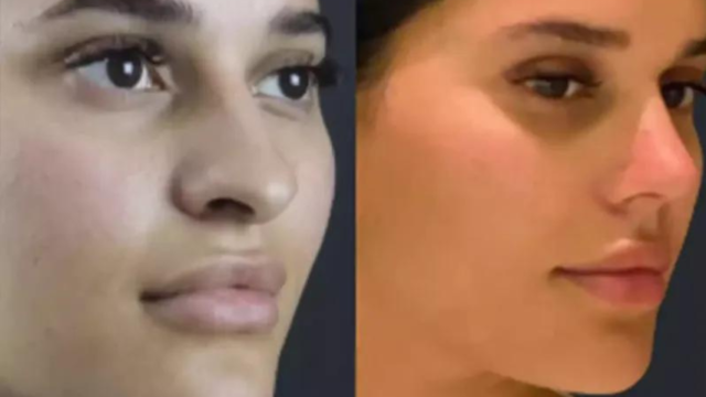 The Ultimate Guide to Rhinoplasty in Dubai: Costs, Types, and Results